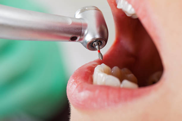 Best Emergency Root Canal Treatment in Breckinridge Center, KY